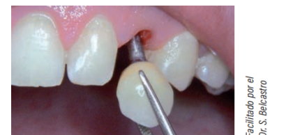 Cementación extra oral