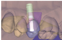 PRÓTESIS CAD-CAM